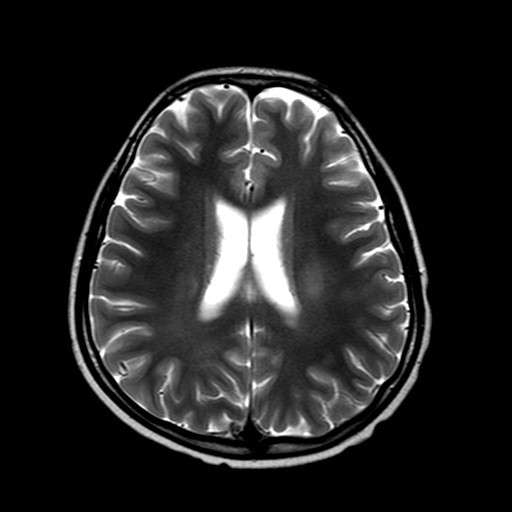 MRI Brain T2W